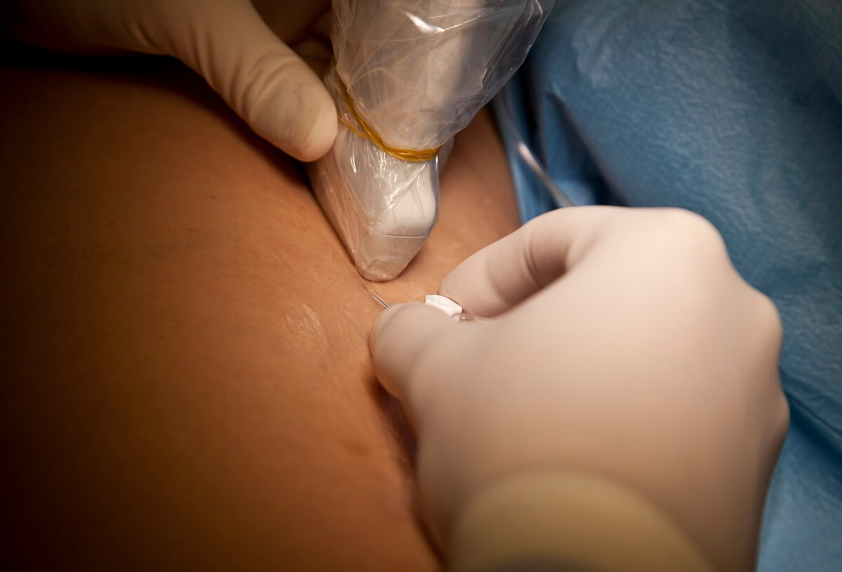ultrasound probe cover for IV placement