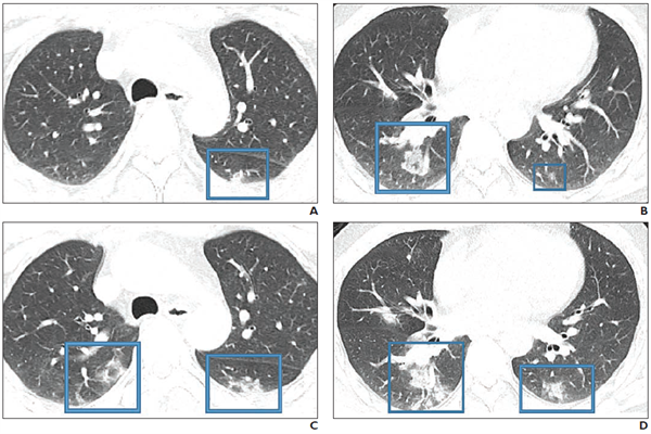 Medical imaging showing lungs infected with novel coronavirus 2019 (COVID-19)