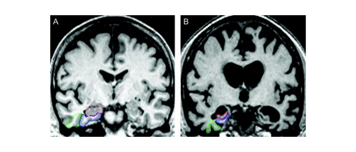 Possible ultrasound treatment for Alzheimer's disease